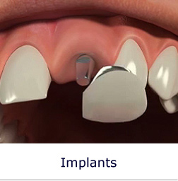 Implants